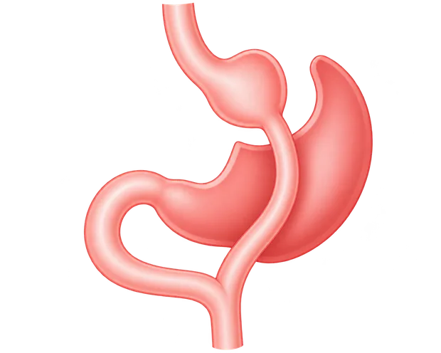 Ilustración del bypass gástrico con reservorio y nuevo recorrido intestinal