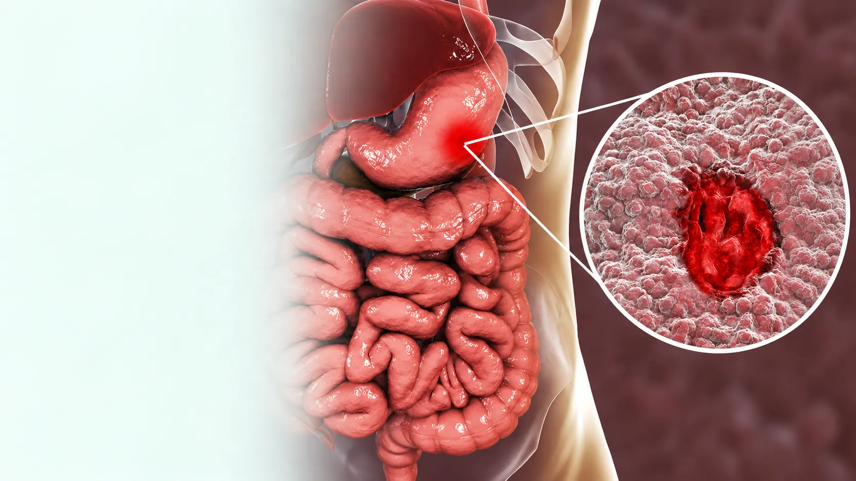 Ilustración del aparato digestivo con detalle ampliado de una lesión de la mucosa gástrica