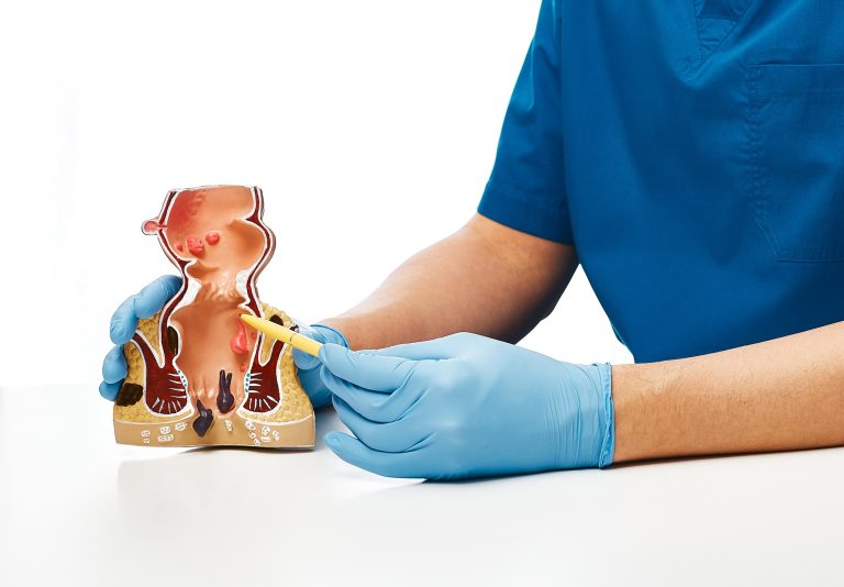Proctologist pointing pen rectum pathologies on an anatomical model. Treatment of rectal diseases,