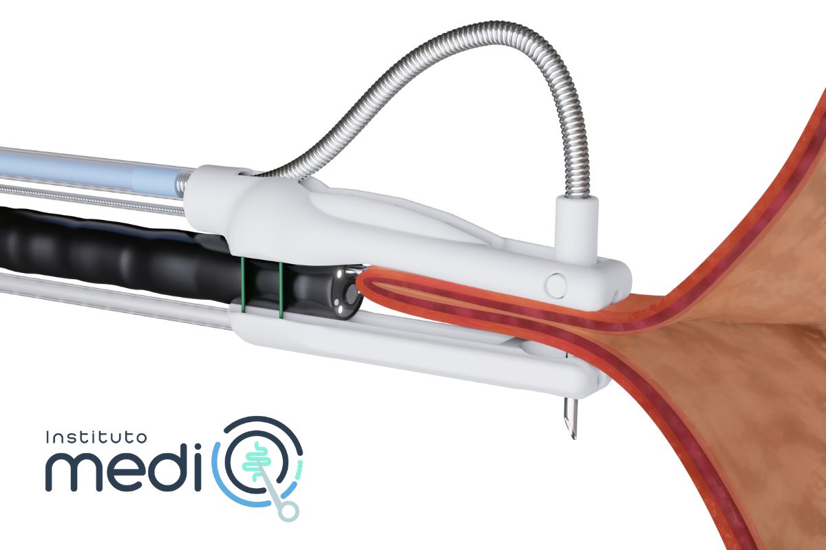 cirugia bariatrica endoscopica