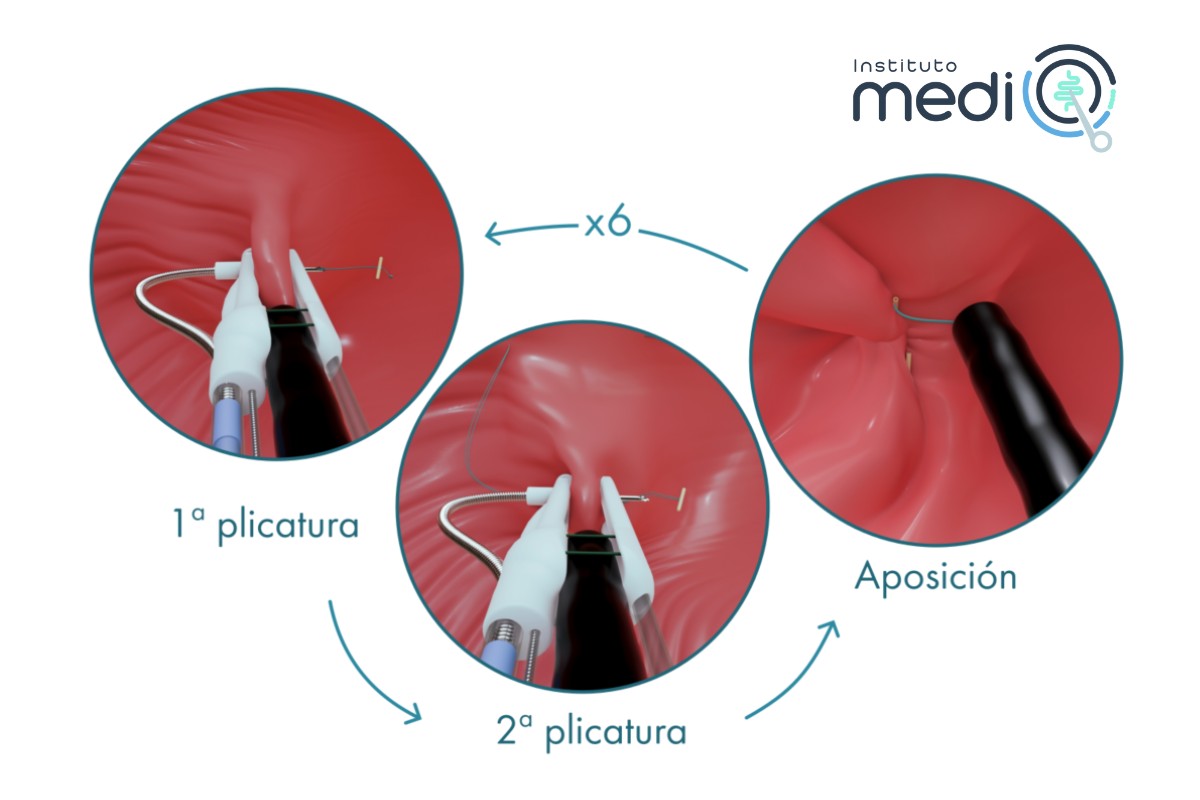 cirugía bariátrica endoscópica Endomina
