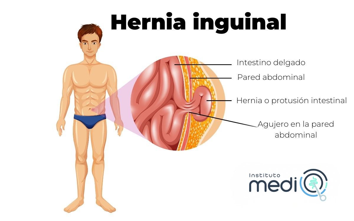 hernia inguinal