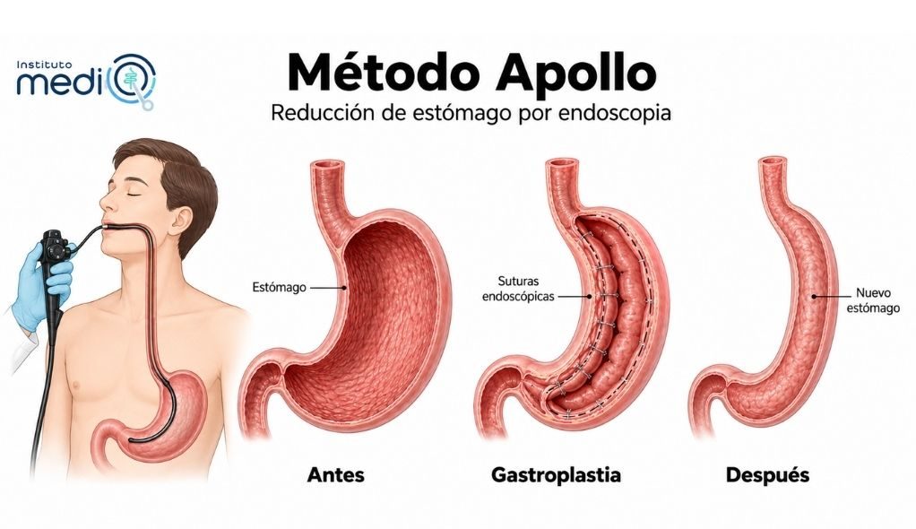 Método Apollo