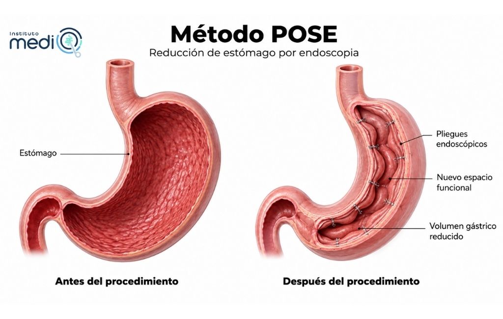 Método Pose