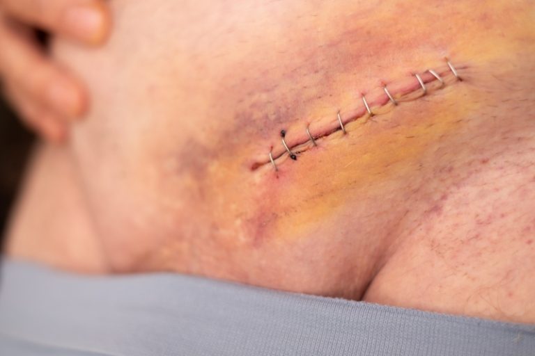 Hernia Inguinal Laparoscópica