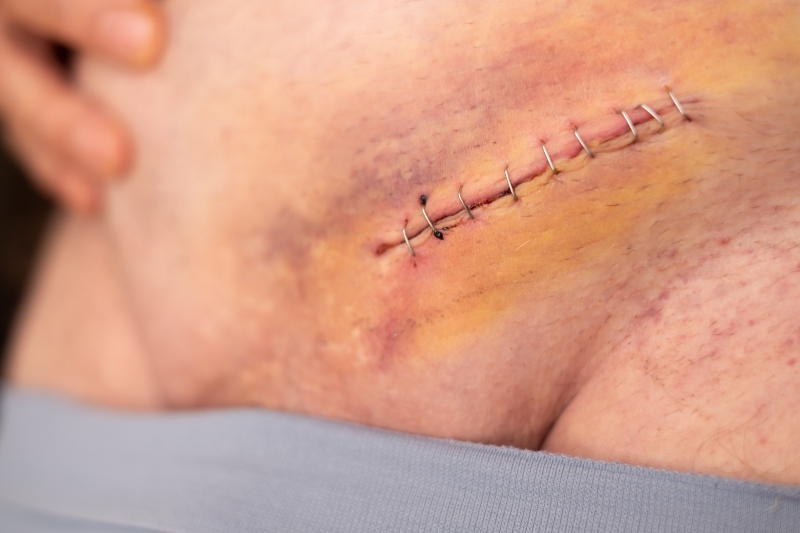 Hernia Inguinal Laparoscópica