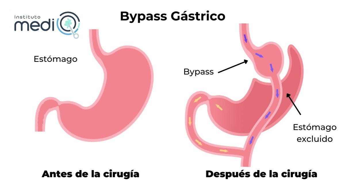 bypass gastrico
