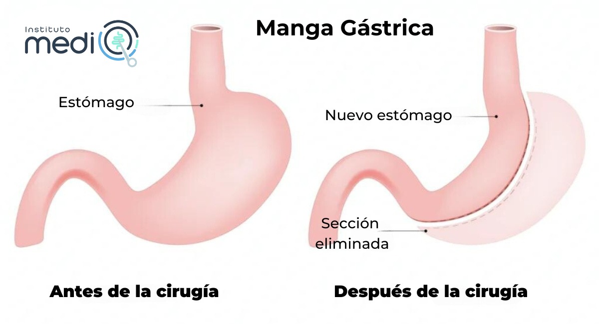 manga gastrica turquia
