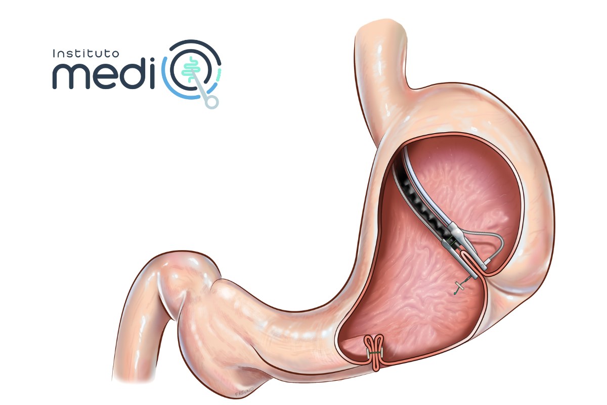 reduccion estomago endomina gastroplastia endoscopica